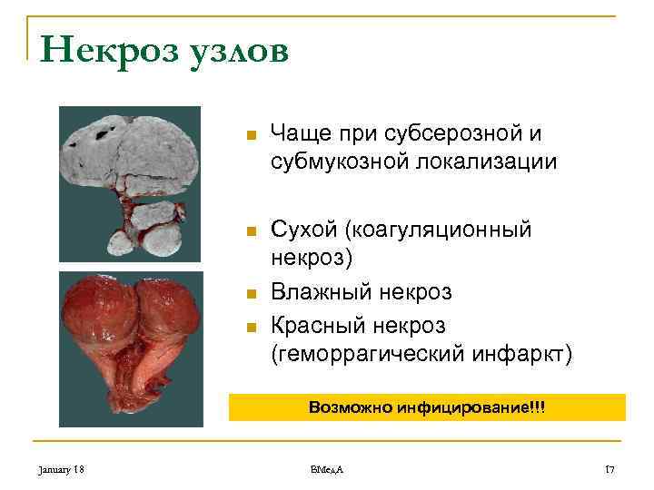 Некроз узлов n Чаще при субсерозной и субмукозной локализации n Сухой (коагуляционный некроз) Влажный