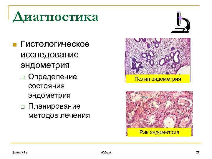 Диагностика n Гистологическое исследование эндометрия q q Определение состояния эндометрия Планирование методов лечения Полип