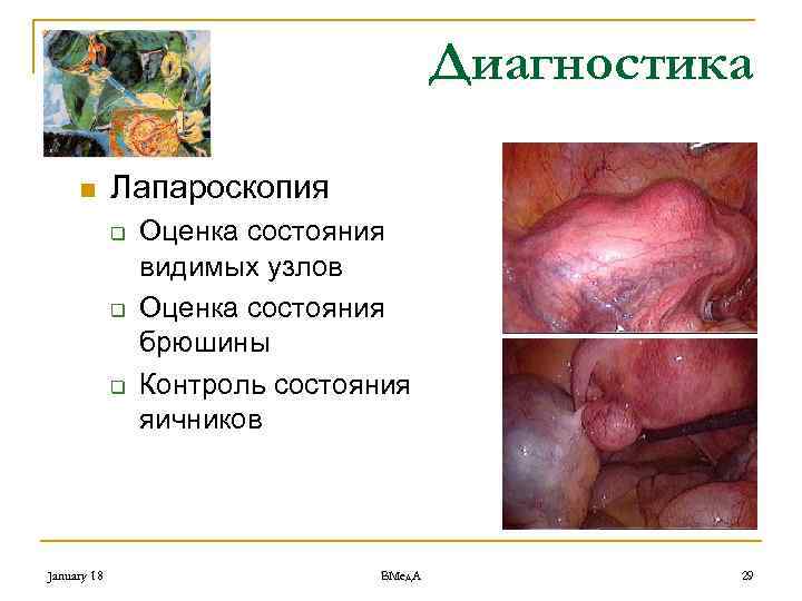 Диагностика n Лапароскопия q q q January 18 Оценка состояния видимых узлов Оценка состояния