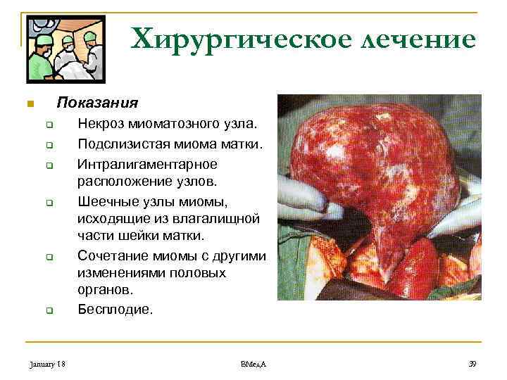 Хирургическое лечение Показания n q q q January 18 Некроз миоматозного узла. Подслизистая миома