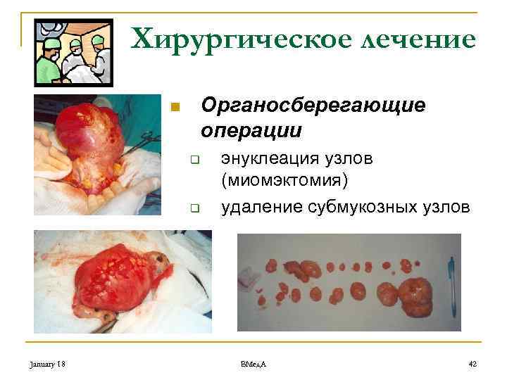 Хирургическое лечение Органосберегающие операции n q q January 18 энуклеация узлов (миомэктомия) удаление субмукозных
