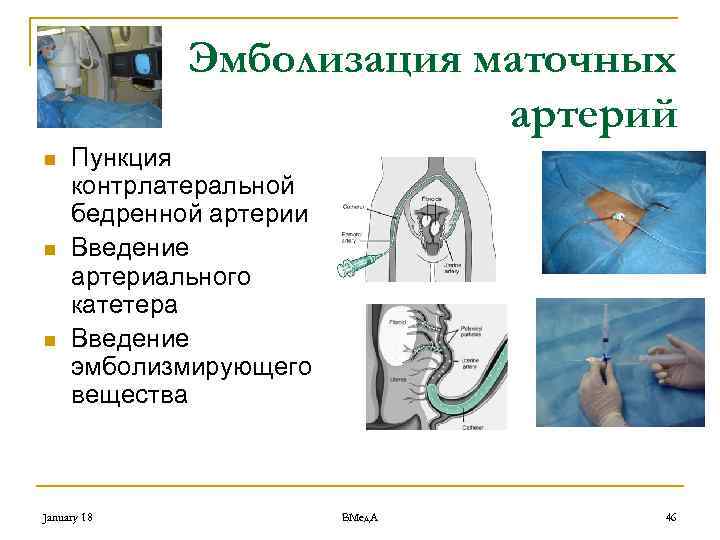 Эмболизация маточных артерий n n n Пункция контрлатеральной бедренной артерии Введение артериального катетера Введение