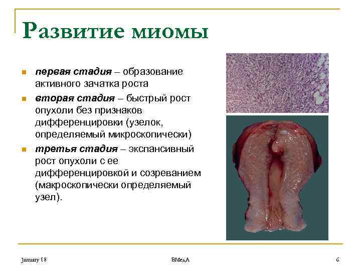 Развитие миомы n n n первая стадия – образование активного зачатка роста вторая стадия
