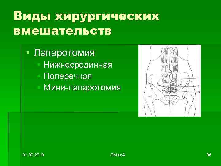 Виды хирургических вмешательств § Лапаротомия § Нижнесрединная § Поперечная § Мини-лапаротомия 01. 02. 2018