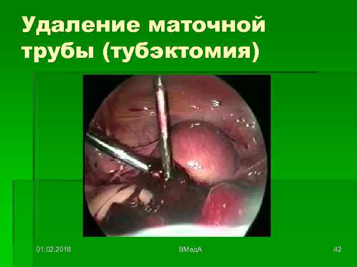 Удаление маточной трубы (тубэктомия) 01. 02. 2018 ВМед. А 42 