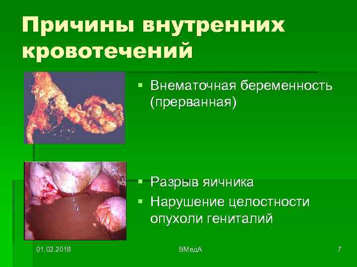 Причины внутренних кровотечений § Внематочная беременность (прерванная) § Разрыв яичника § Нарушение целостности опухоли