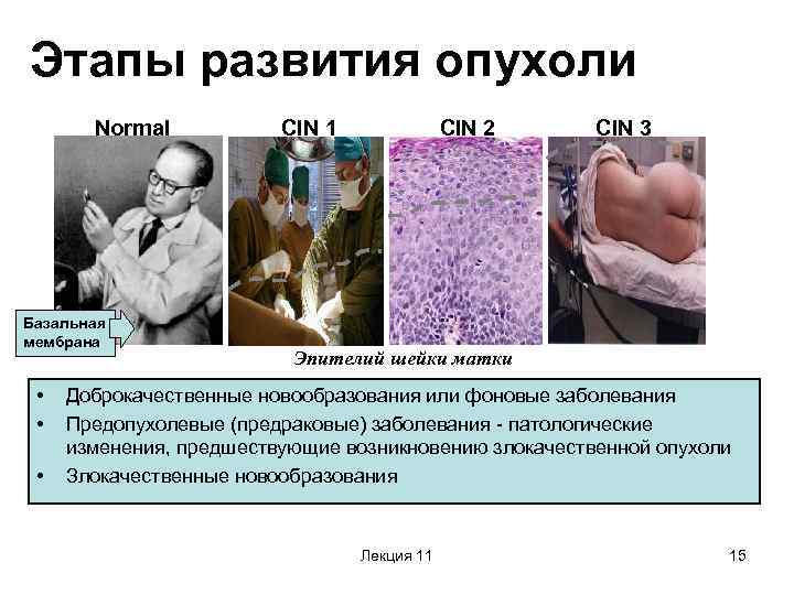 Этапы развития опухоли Normal Basal Базальная cell layer мембрана • • • CIN 1