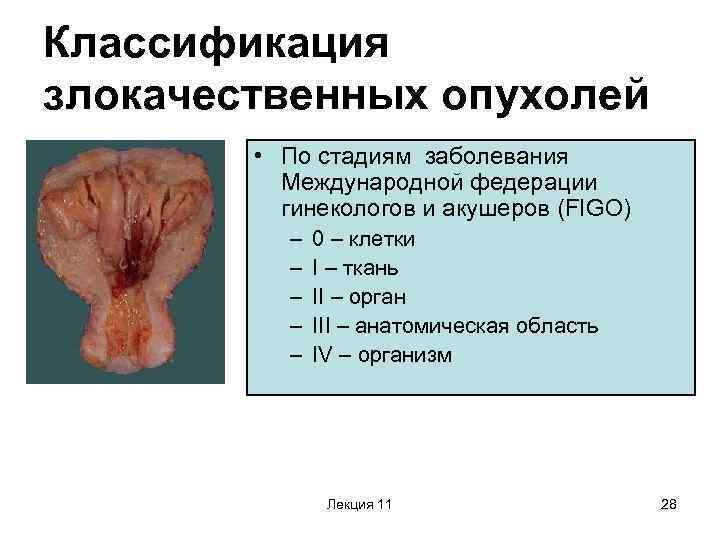 Классификация злокачественных опухолей • По стадиям заболевания Международной федерации гинекологов и акушеров (FIGO) –