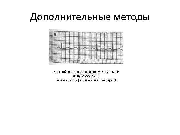 Дополнительные методы Двугорбый широкий высокоамплитудный Р (гипертрофия ЛП) Весьма часто- фибрилляция предсердий 