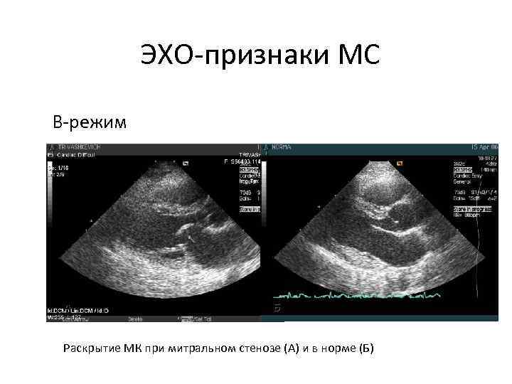 ЭХО-признаки МС В-режим А Б Раскрытие МК при митральном стенозе (А) и в норме