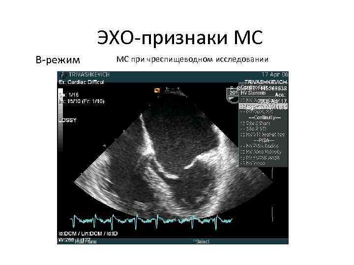 Эхо признаки. Эхопризнаки митрального стеноза. Эхо признаки митрального стеноза. Эхо-признаки что это значит.