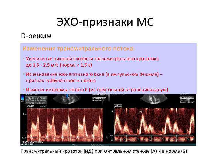 Эхо признаки. Трансмитральный кровоток норма. Трансмитральный кровоток 1 типа. Трансмитральный диастолический поток. Скорость трансмитрального кровотока.