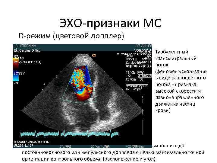 Уз картина. Доплер митральном стенозе допплер. Разнонаправленное движение створок митрального клапана. Турбулентный трансмитральный поток.