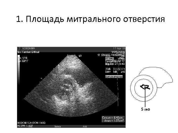 1. Площадь митрального отверстия S мо 