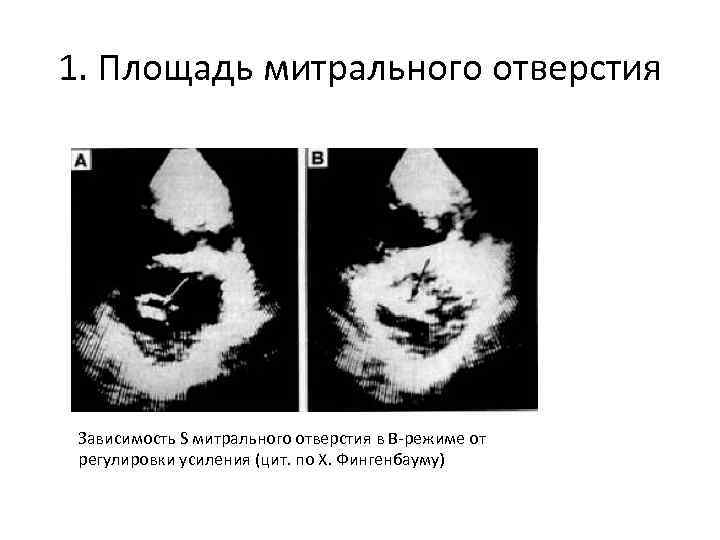 1. Площадь митрального отверстия Зависимость S митрального отверстия в В-режиме от регулировки усиления (цит.