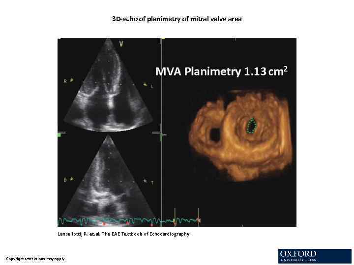 3 D-echo of planimetry of mitral valve area Lancellotti, P. et. al. The EAE