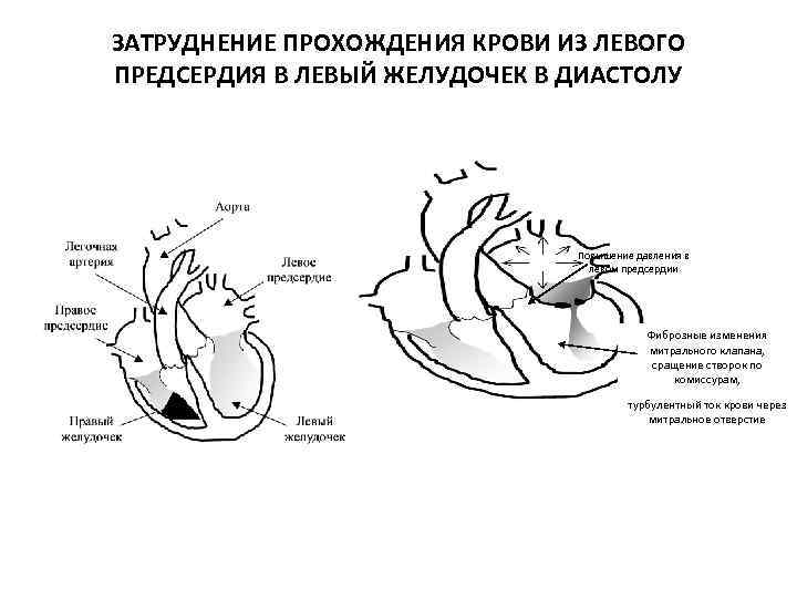 Стеноз митрального клапана схема