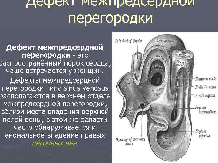 Дефект межжелудочковой перегородки у детей презентация