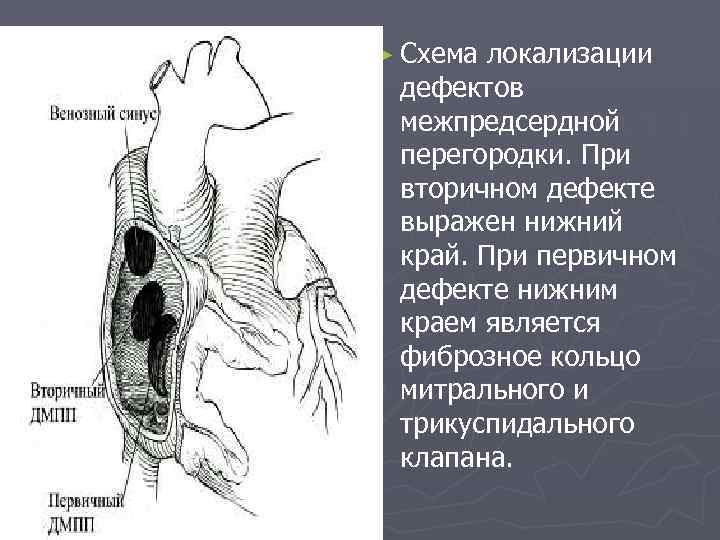 Дефект межжелудочковой перегородки картинки