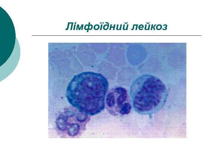 Лімфоїдний лейкоз 