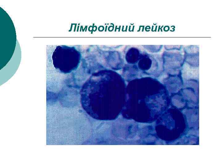 Лімфоїдний лейкоз 