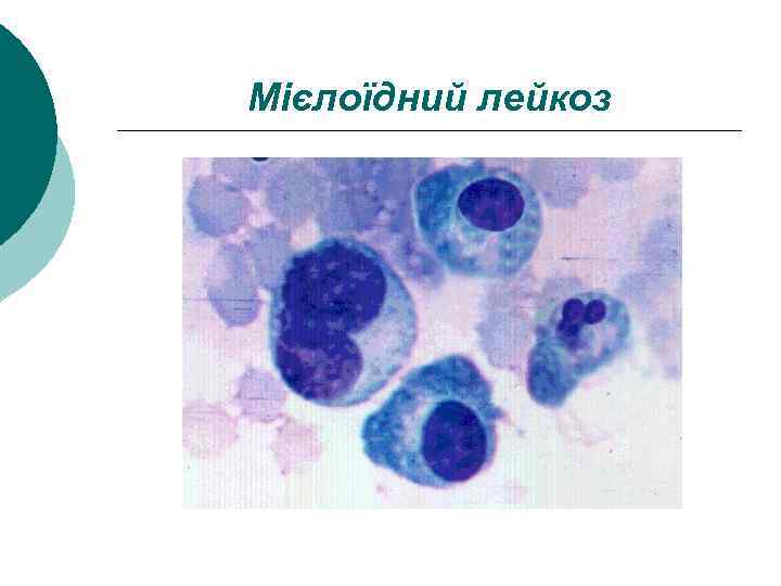 Мієлоїдний лейкоз 