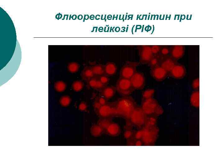 Флюоресценція клітин при лейкозі (РІФ) 