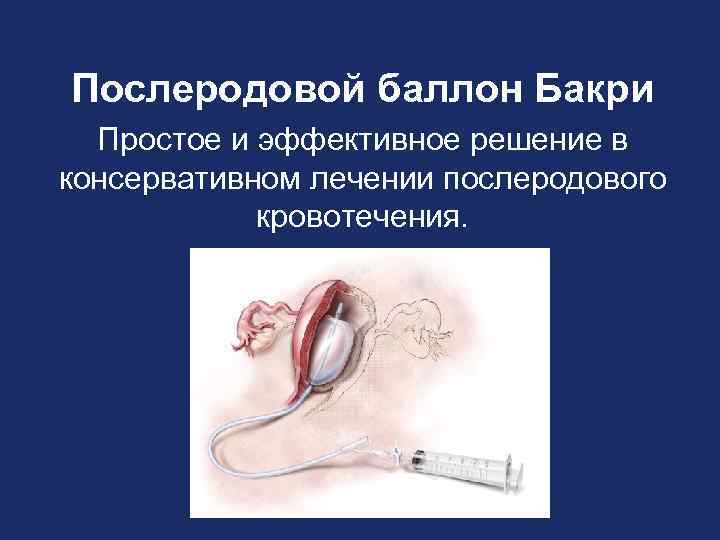 Послеродовой баллон Бакри Простое и эффективное решение в консервативном лечении послеродового кровотечения. 