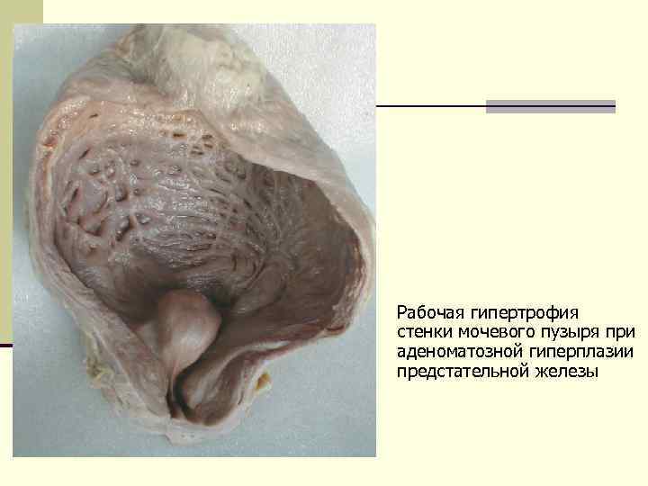 Рабочая гипертрофия стенки мочевого пузыря при аденоматозной гиперплазии предстательной железы 