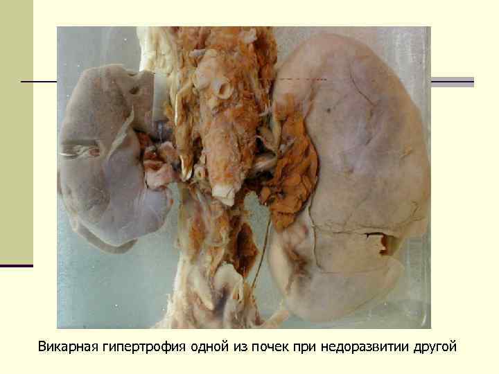 Викарная гипертрофия одной из почек при недоразвитии другой 