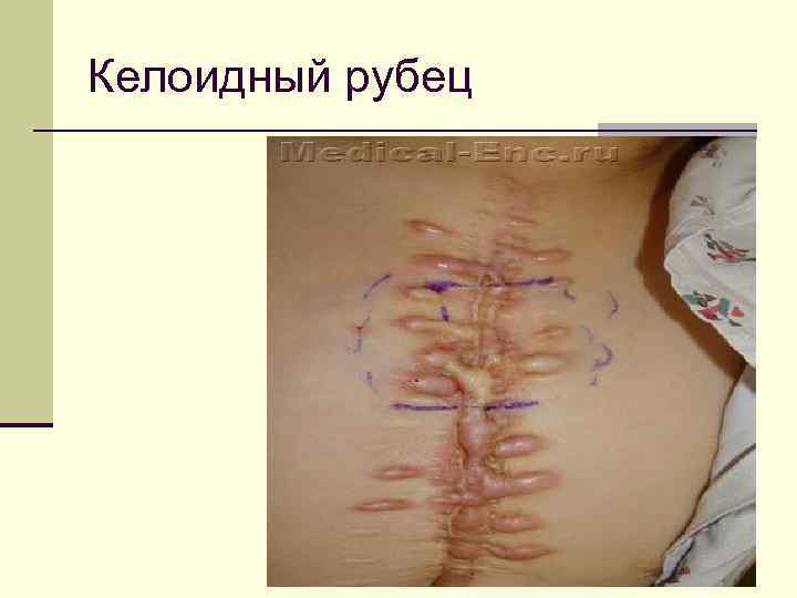 Келоидный рубец 