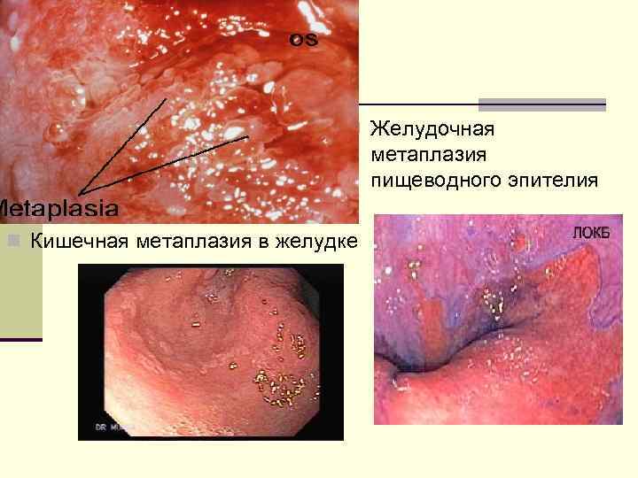  n Желудочная метаплазия пищеводного эпителия n Кишечная метаплазия в желудке 