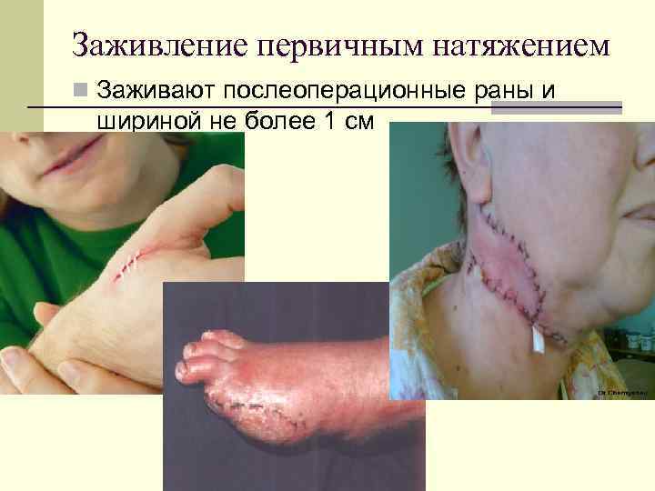 Заживление первичным натяжением n Заживают послеоперационные раны и шириной не более 1 см 