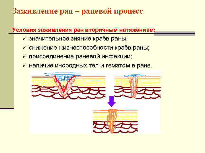 Заживление ран после. Заживление РАН вторичным натяжением. Рана заживает вторичным натяжением. Заживление раны (раневой процесс). Условия заживления вторичным натяжением.