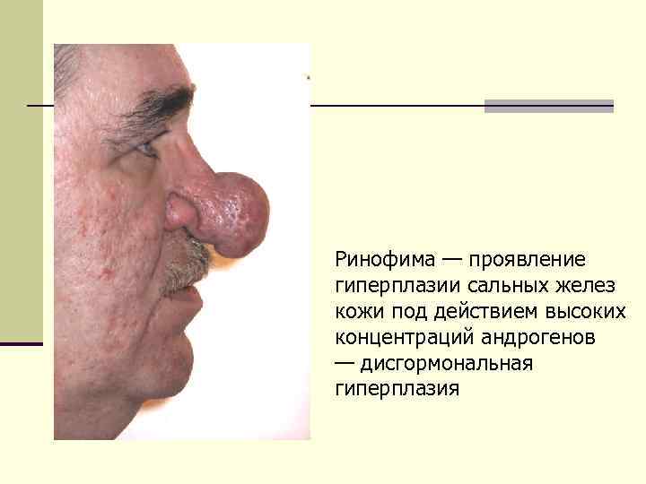 Ринофима — проявление гиперплазии сальных желез кожи под действием высоких концентраций андрогенов — дисгормональная