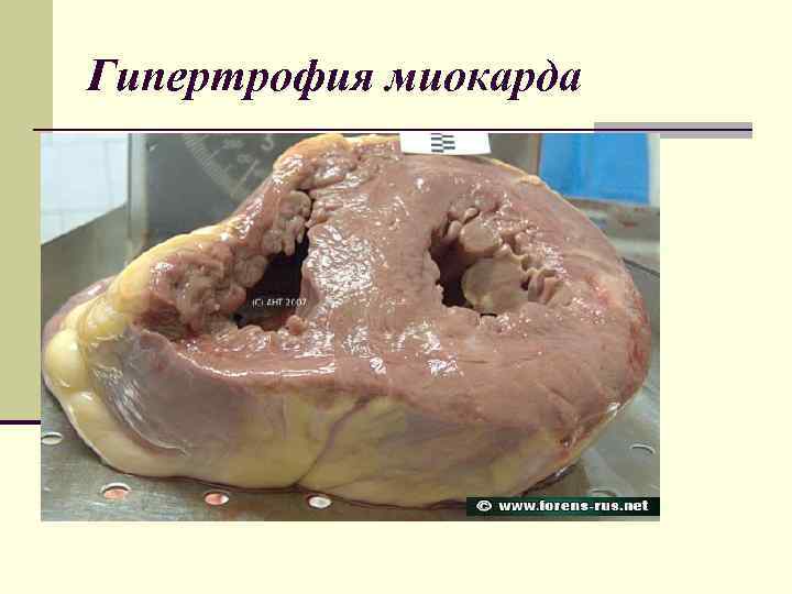 Гипертрофия миокарда 