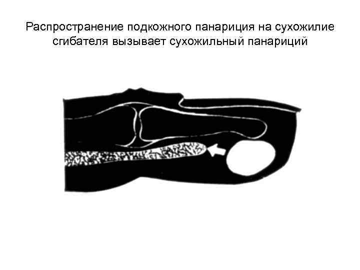 Распространение подкожного панариция на сухожилие сгибателя вызывает сухожильный панариций 