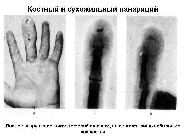 Костный и сухожильный панариций Полное разрушение кости ногтевой фаланги, на ее месте лишь небольшие