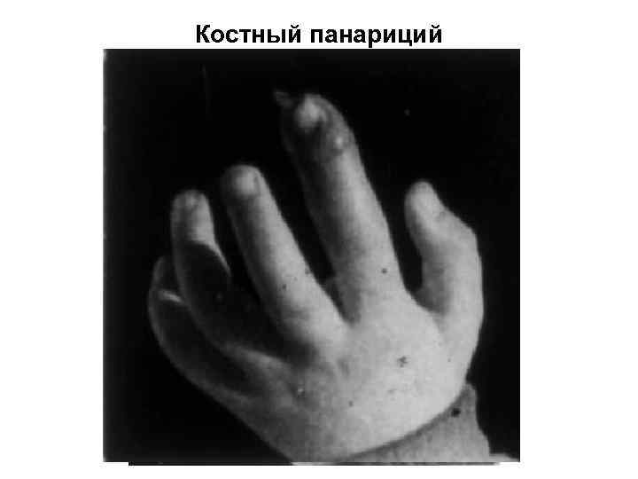 Костный панариций 