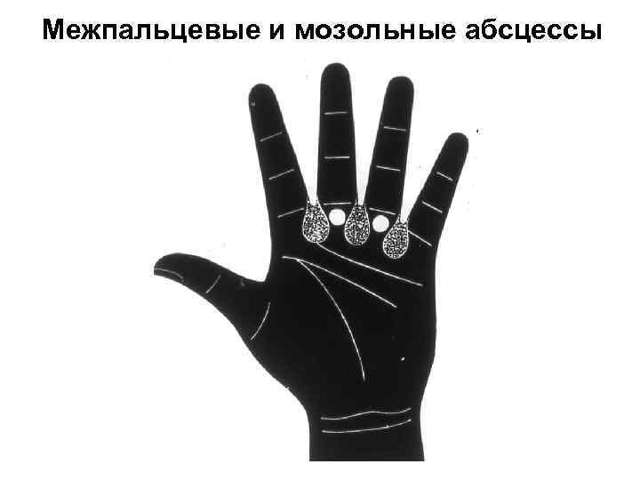 Межпальцевые и мозольные абсцессы 