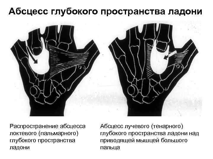 Абсцесс глубокого пространства ладони Распространение абсцесса локтевого (пальмарного) глубокого пространства ладони Абсцесс лучевого (тенарного)