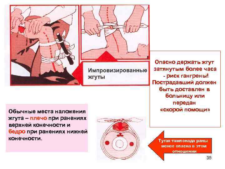 Обычные места наложения жгута – плечо при ранениях верхней конечности и бедро при ранениях