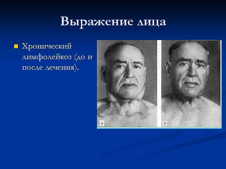 Выражение лица n Хронический лимфолейкоз (до и после лечения). 