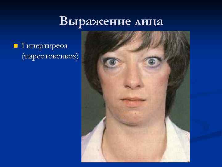 Выражение лица n Гипертиреоз (тиреотоксикоз) 