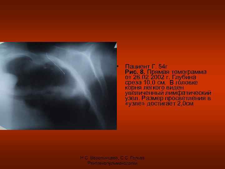  • Пациент Г. 54 г Рис. 8. Прямая томограмма от 26. 02 2002