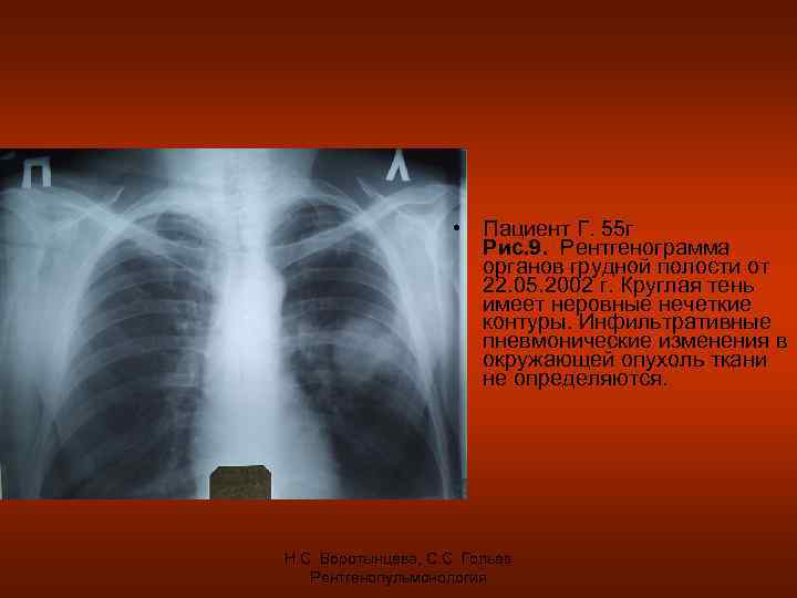  • Пациент Г. 55 г Рис. 9. Рентгенограмма органов грудной полости от 22.
