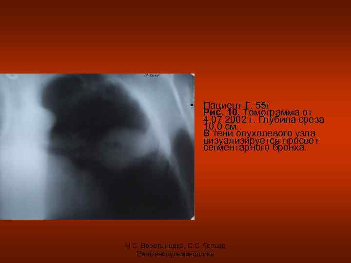 • Пациент Г. 55 г Рис. 10. Томограмма от 4. 07 2002 г.