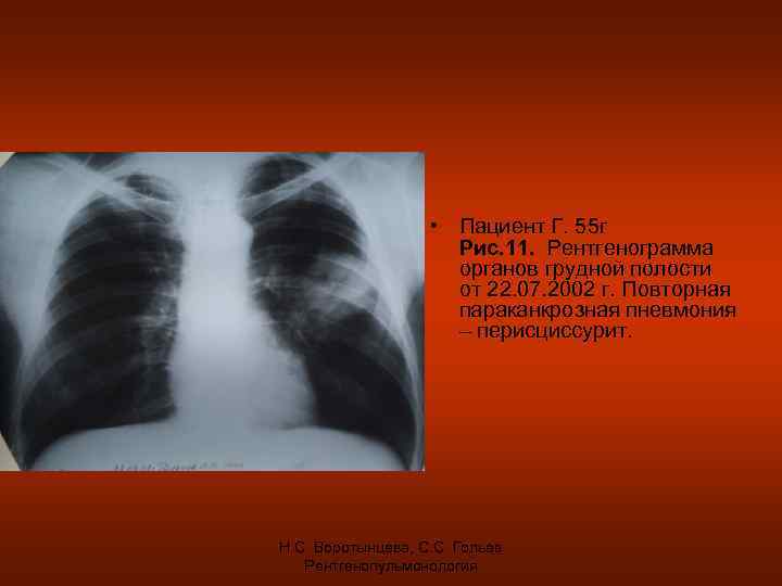  • Пациент Г. 55 г Рис. 11. Рентгенограмма органов грудной полости от 22.