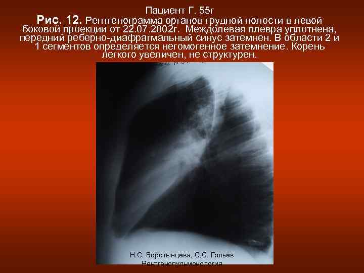 Пациент Г. 55 г Рис. 12. Рентгенограмма органов грудной полости в левой боковой проекции