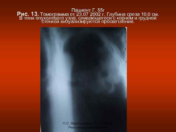 Пациент Г. 55 г Рис. 13. Томограмма от 23. 07 2002 г. Глубина среза
